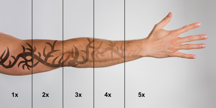 Tattoo Removal Costs Explained: From Single Sessions to Full Fades