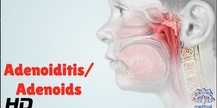 Adenoiditis: Symptoms, Causes, and Treatment Options